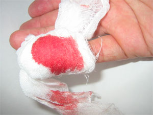 血が止まりません